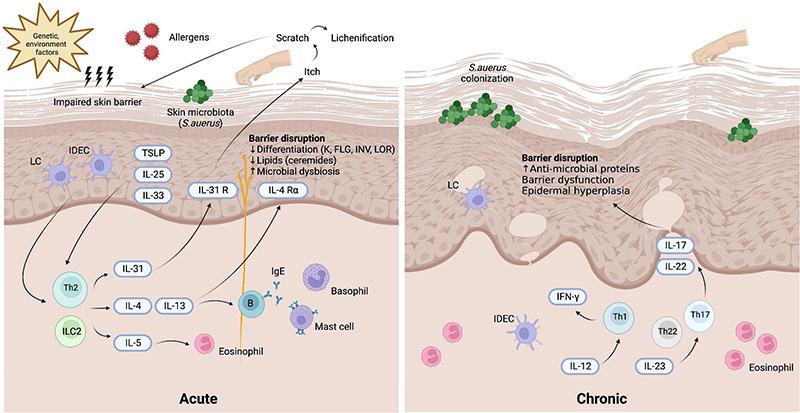 Atopic Dermatitis (AD)