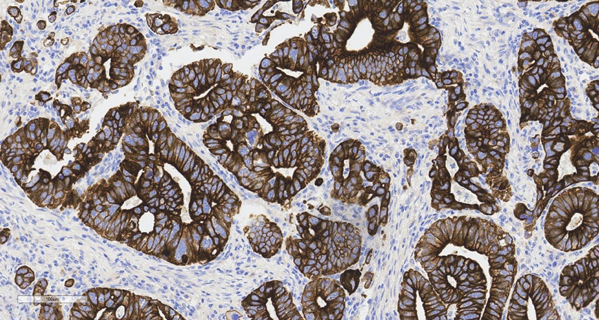 Human Colorectal Cancer (FFPE) – 20x