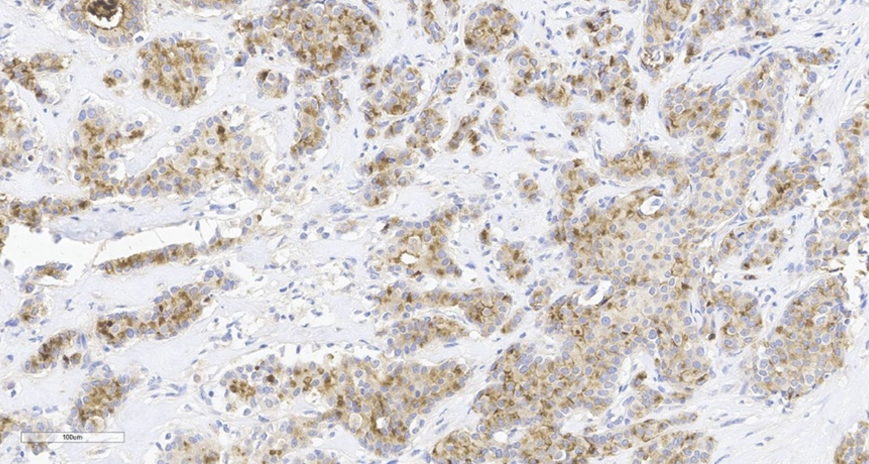 Human Breast Cancer (FFPE) – 20x