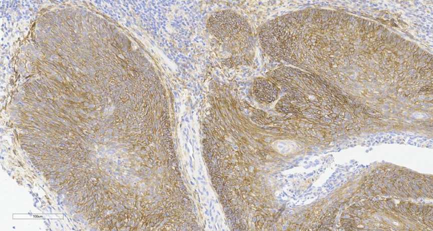 Human Cervical Cancer – 20x