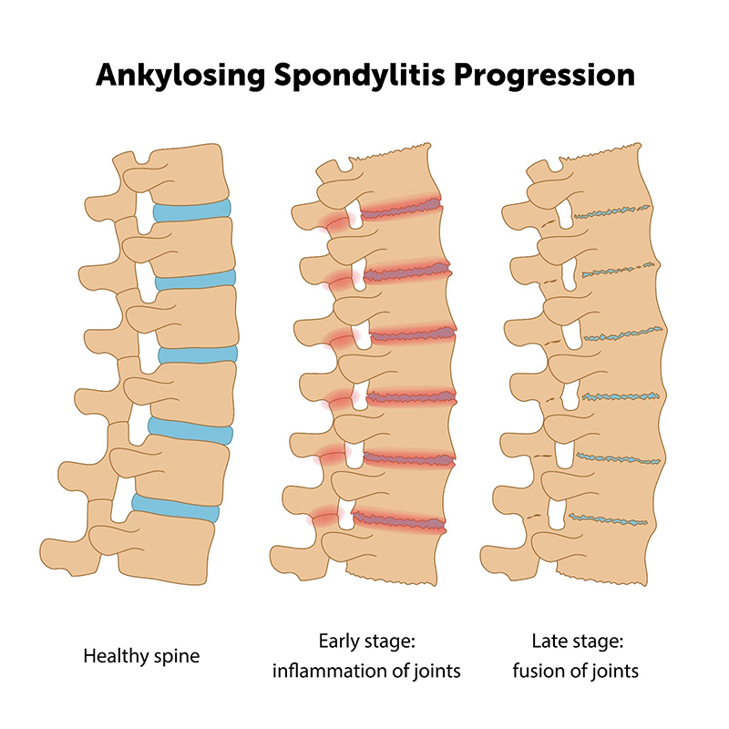 Progression of AS