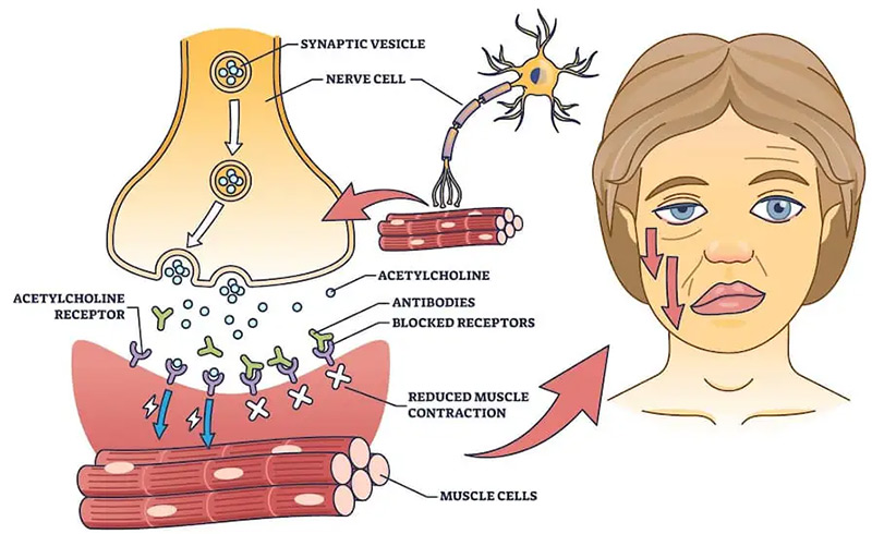Pathogenesis and pathological features of MG