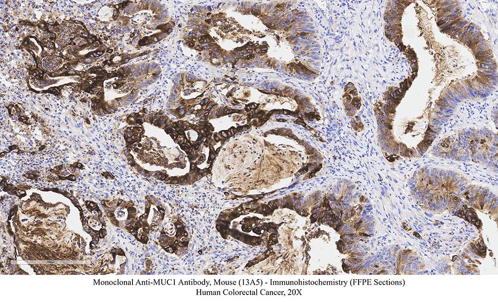 Mucin-1 SAMPLE STAINING DATA