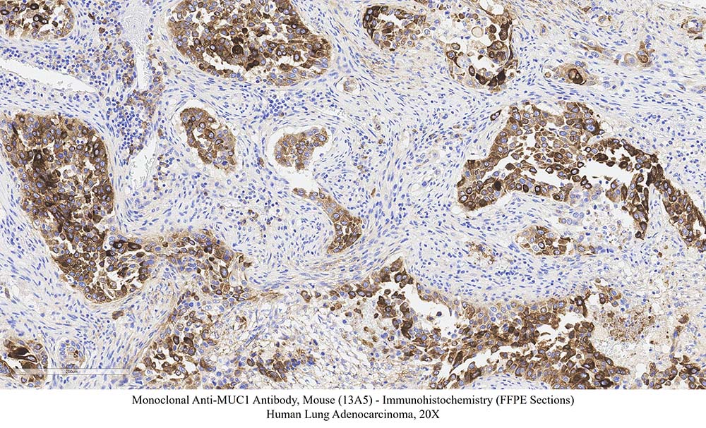 Mucin-1 SAMPLE STAINING DATA