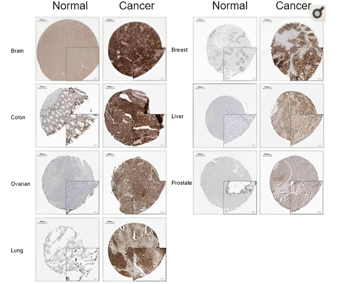 Fatty Acid Oxidation and Liver Tumor Growth